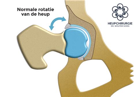 Penanganan Impingement Heup pada Laki-Laki Usia 35-55 Tahun