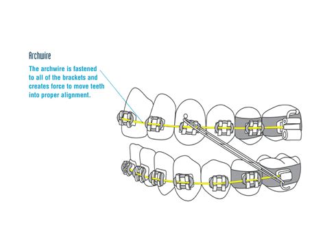 Evaluasi Dimensi dan Morfologi Slot Orthodontics: Penelitian Baru