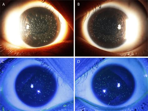 Sclerotic Scatter: A Phenomenon that Reveals Hidden Details of the Cornea