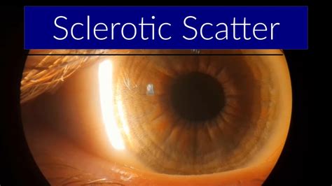 Aplikasi Sclerotic Scatter dalam Klinis