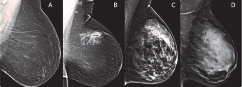 Kontrast Digital Mammogram dan Pilihan Screening untuk Kanker Payudara