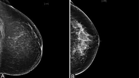 Risiko dan Faktor yang Berpengaruh terhadap Tissue Fibroglandular pada Payudara